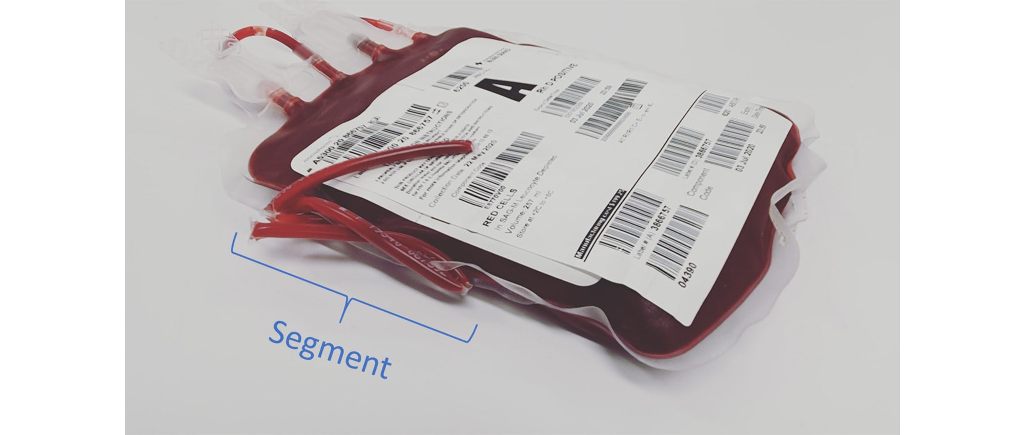 An RBC blood bag, with segment tubing labeled