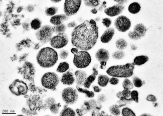 Electron micrograph of microparticles found in the supernatant of a freshly prepared RBC unit. Microparticles ranged from 50-600 nm in diameter, with many around 200 nm. Photo credit: BSRI, Adapted from Danesh et al., Blood 123:687-96 (2014).