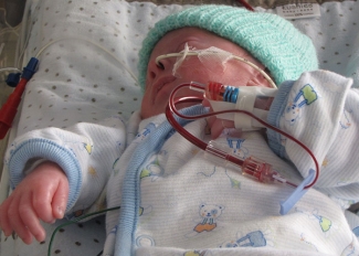 A premature baby, Nicholas Clark, receives a blood transfusion in hospital.