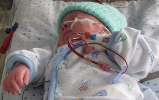 A premature baby, Nicholas Clark, receives a blood transfusion in hospital.